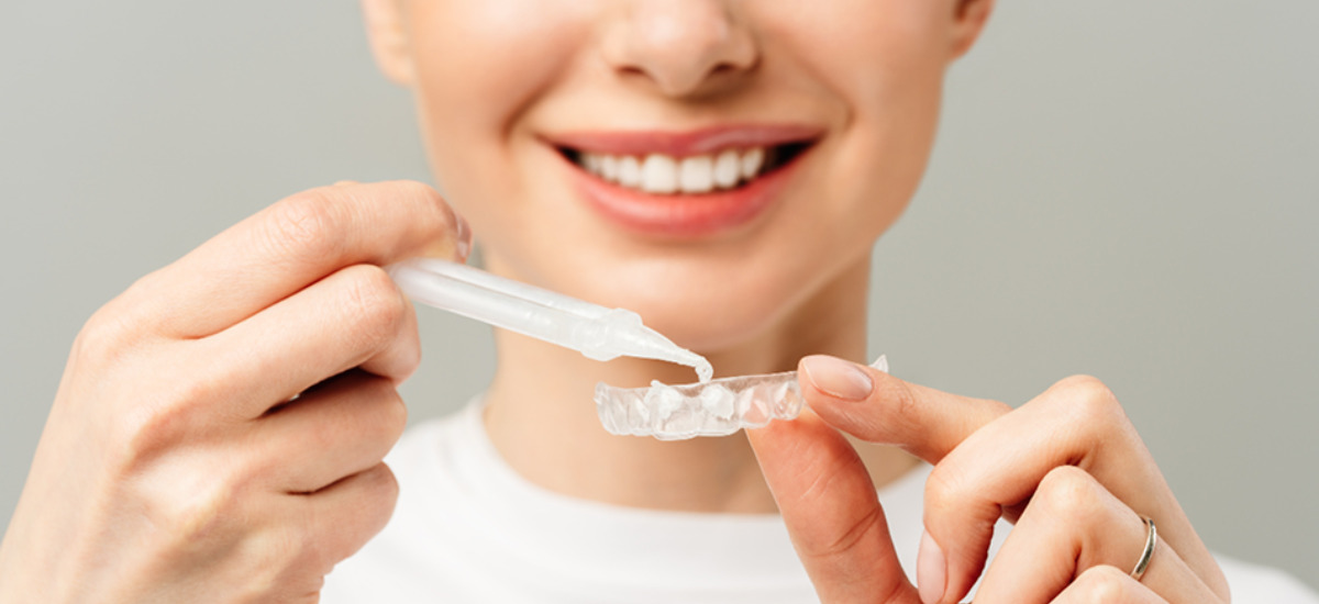 ホワイトニングの種類と選び方