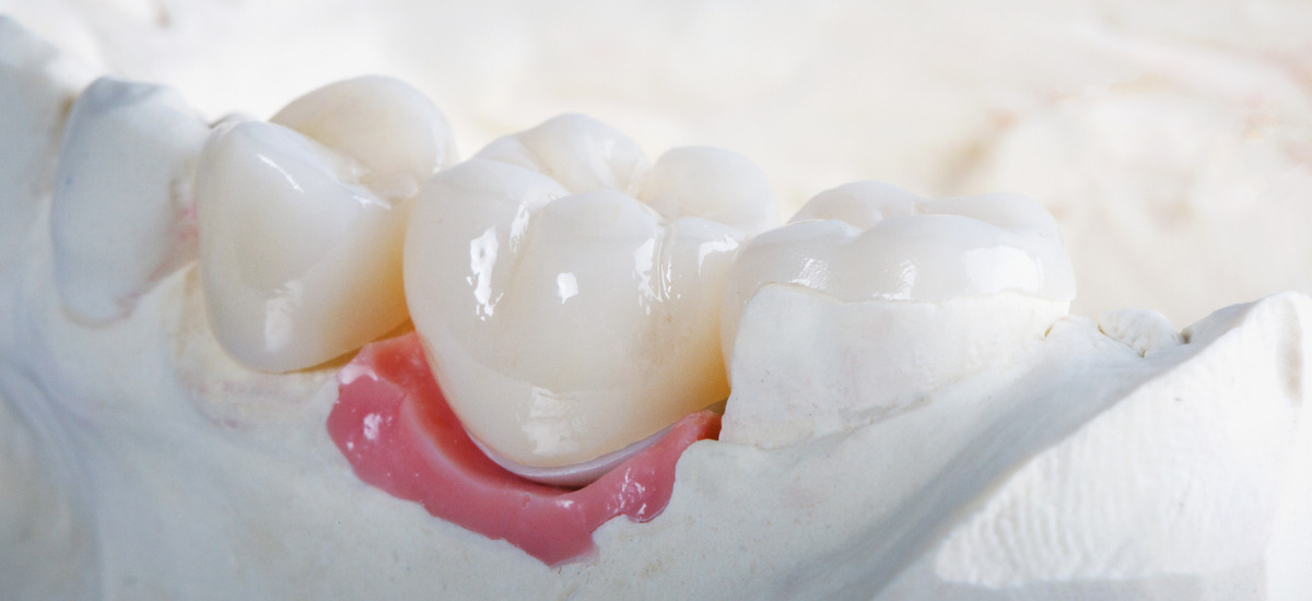 見た目も自然に：詰め物・被せ物の種類と特徴