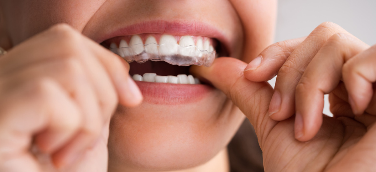 治療法①：ナイトガード（スプリント）療法【保険適用】