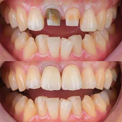 審美歯科セラミック治療症例