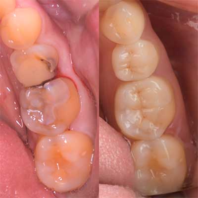 審美歯科セラミック治療症例