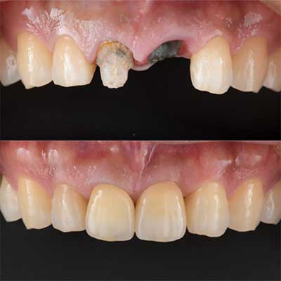 精密インプラント治療症例