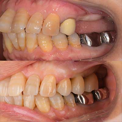 精密インプラント治療症例