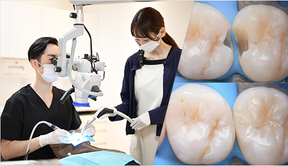 なるべく痛みがなく、削らない、負担のない治療